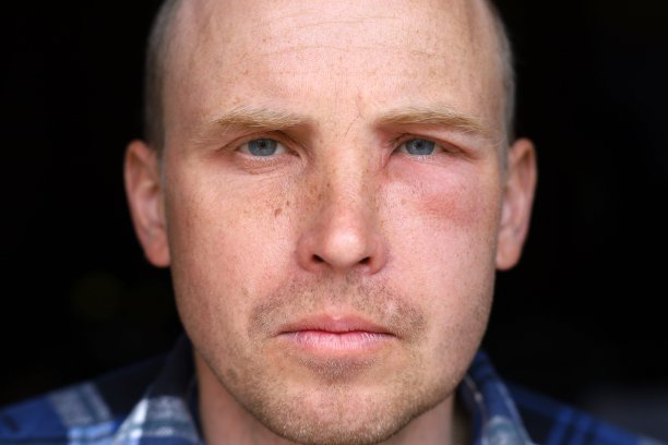 被蜜蜂蛰伤后脸部肿胀图片下载