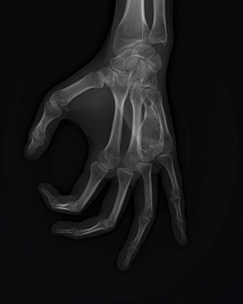 手部动脉瘤样骨囊肿X光片图片下载