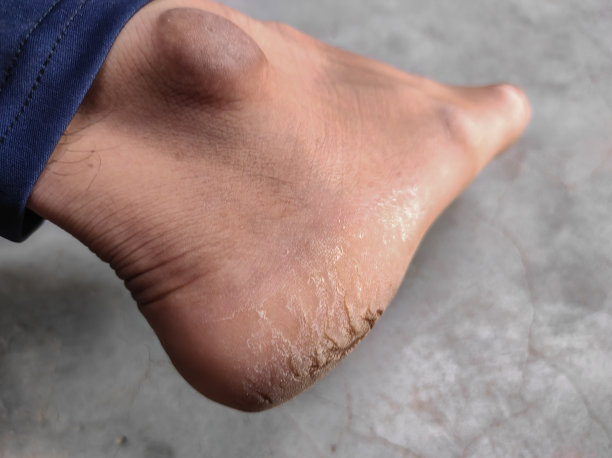 破裂的脚踝照片的特写背景蓝色图片下载