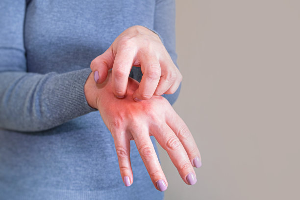 一个年轻的女人抓她的手。皮肤炎症。皮肤病的问题。卫生的手部皮肤护理理念。图片下载