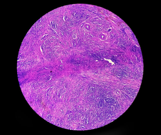 皮肤癌:显微镜下皮肤活检显示基底细胞癌。图片下载