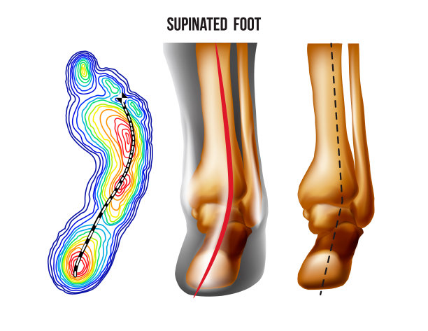 旋足，足弓变形，底部和背部视图。脚的重量分布。图片下载