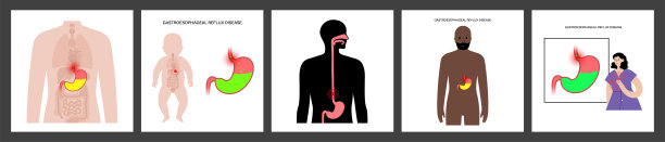 胃食管反流图片下载