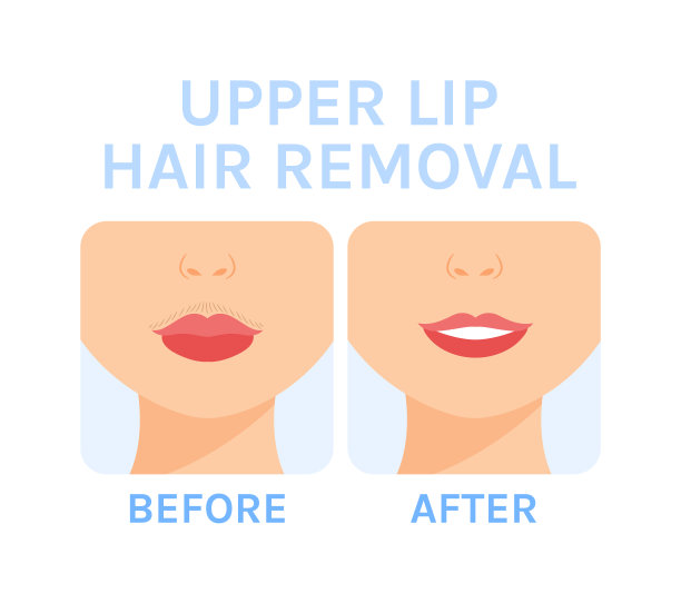 女性的胡子。去除嘴唇上方多余的毛发。脱毛。之前。清洁皮肤和微笑在脸上。卡通色彩风格。白色背景。矢量插图为美容美容设计。图片下载