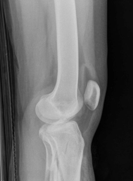 膝盖X光片图片下载