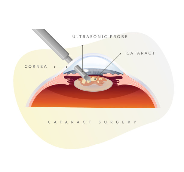 人眼-白内障手术-插图图片下载