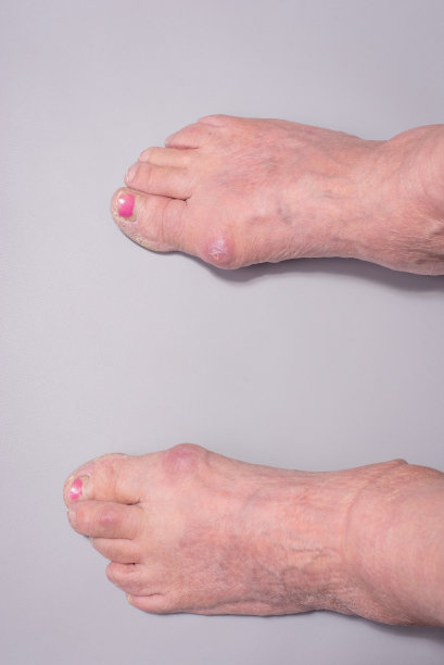 灰色背景下老年妇女大脚趾疾病曲度特写图片下载