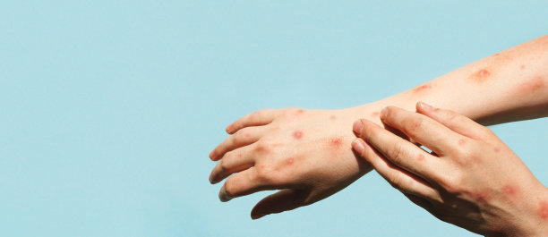 猴痘是一种危害全世界的新疾病。猴痘手。疼痛的皮疹，红点，水泡在手。关闭皮疹，人类的手与健康问题。横幅,复制空间。图片下载
