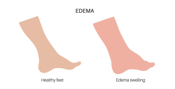 水肿的脚图片下载