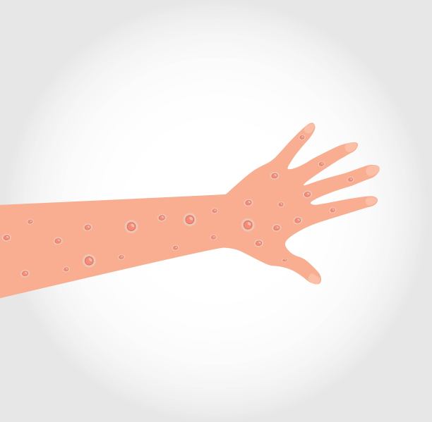 猴痘病毒。手和胳膊上有伤口。矢量图片下载