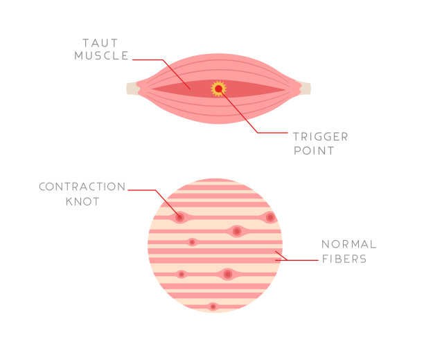 肌肉纵切面上的触发点复合体的插图。肌肉疼痛的原因。图片下载