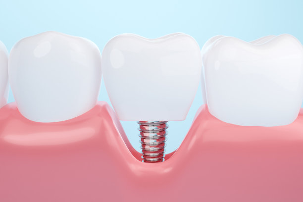 牙科植体治疗图片下载