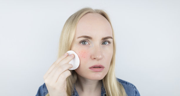 对化妆品过敏。女孩长痘是因为用了劣质的面霜、粉饼或粉底。对不合格或有毒产品的皮肤反应概念。图片下载