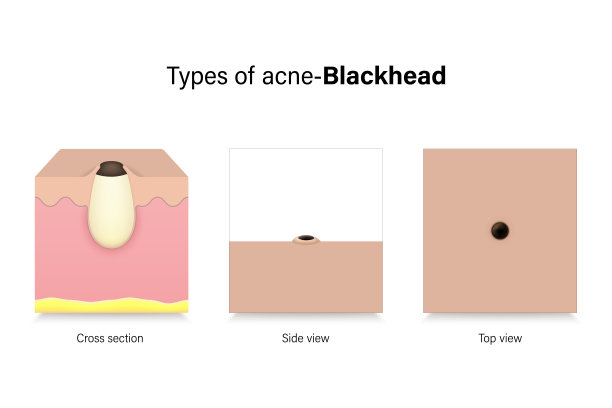 类型的痤疮。皮肤问题。横断面、侧视图和俯视图均为黑头。美容和医疗广告的载体。图片下载