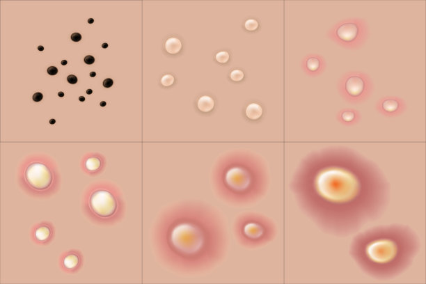 类型的痤疮。皮肤问题。黑头，白头，丘疹，脓疱，结节和囊肿。美容和医疗广告的载体。图片下载