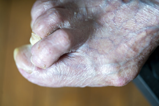 一位患有晚期拇囊炎的女性的脚图片下载