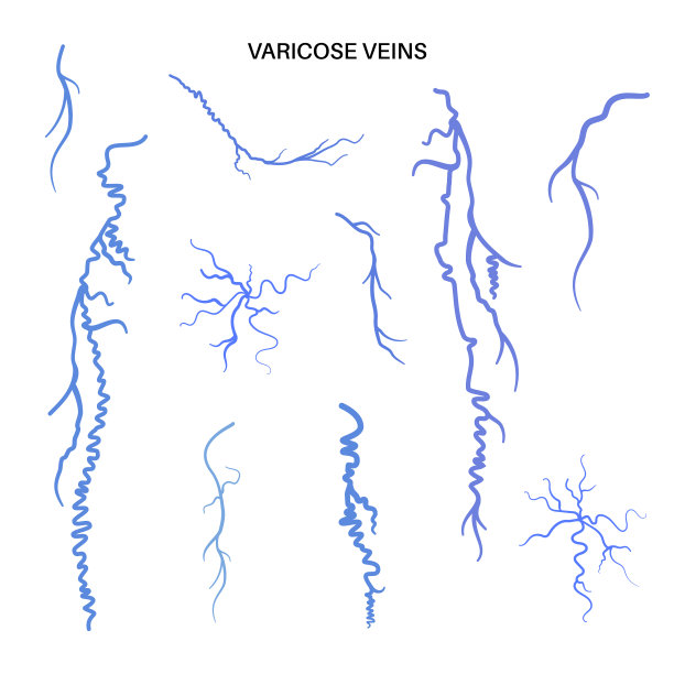 静脉曲张解剖学图片下载
