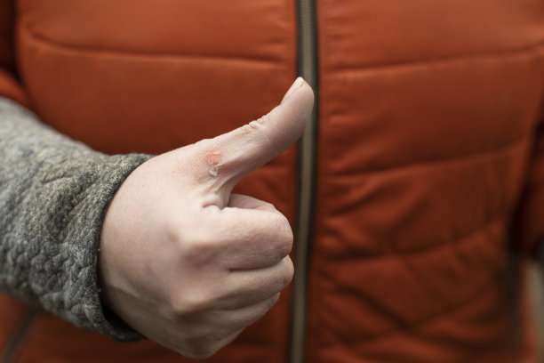 一个皮肤上有伤口的男人的手。受损的手指。图片下载