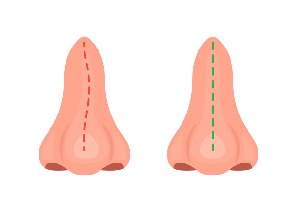 矫正鼻曲度和矫正鼻曲度图片下载