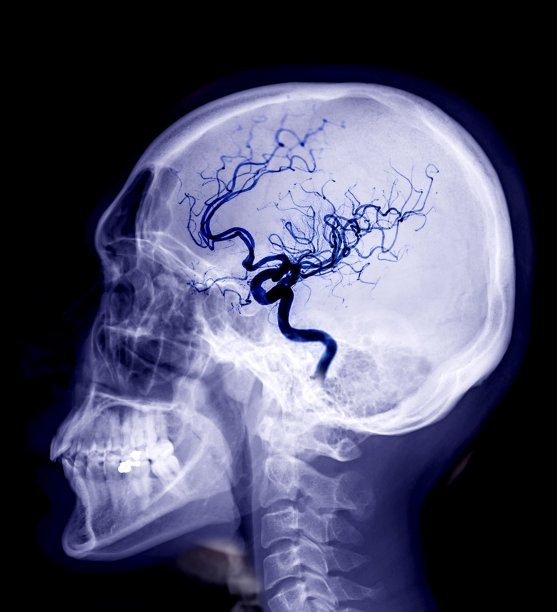 黑色背景分离脑血管造影的人体侧位颅骨x线图像。图片下载
