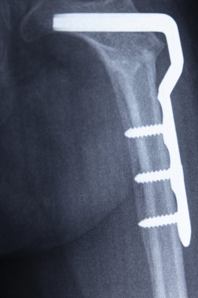 髋部截骨术。骨盆x线片:左大腿发育不良，金属板特写。图片下载