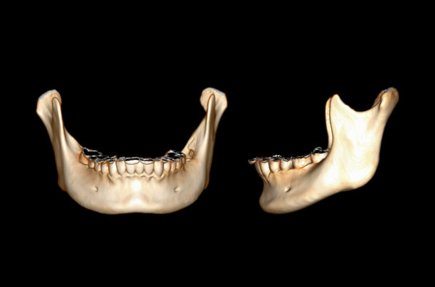 下颌骨三维绘制图像的CT扫描。图片下载