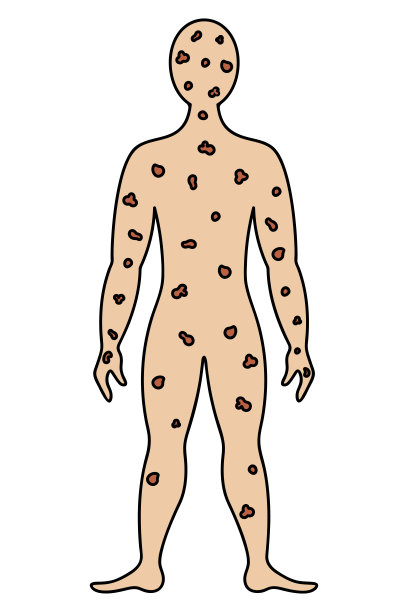 天花在人体上。颜色向量插图。病人的面部和身体布满斑点。肌肉发达的男子。孤立的背景。卡通风格。医学的主题。图片下载