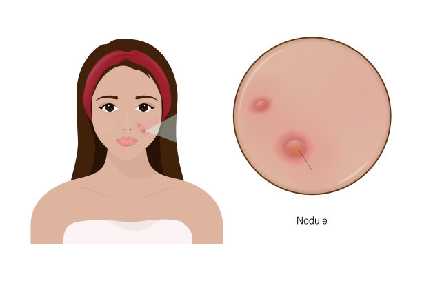 女性痤疮和面部皮肤结节放大的近距离图像。图片下载