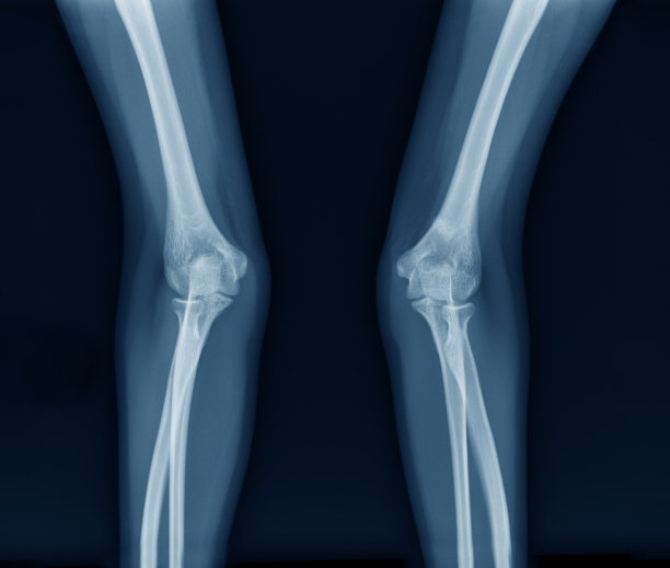 肘关节x线图像图片下载