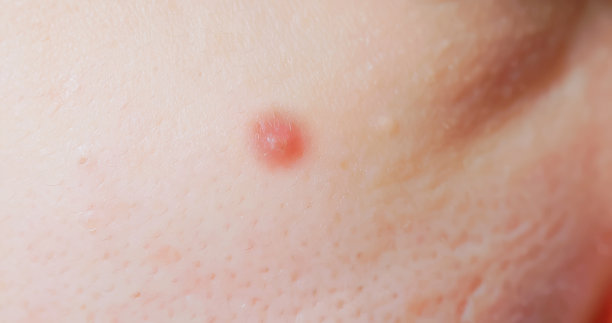 面部痤疮问题图片下载