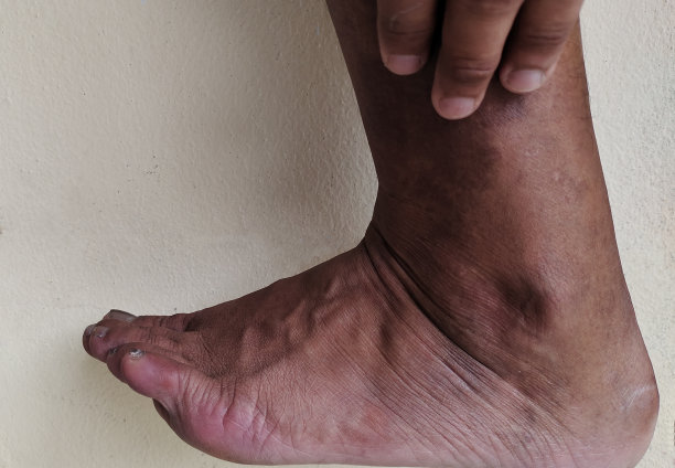 男性患者腿部溃疡和踝关节感染。图片下载