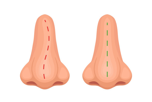 歪而端正的鼻子。鼻子治疗前后。矢量图图片下载
