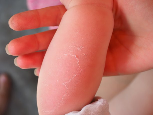 红手小山羊皮肤晒伤。脱皮:孩子手臂上的皮肤脱皮图片下载