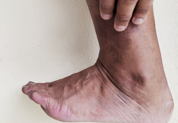 男性患者小腿溃疡和皮肤感染图片下载