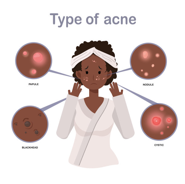 痤疮类型非洲裔美国妇女与痤疮图片下载