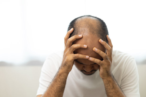 男士脱发特写。年轻人头部发痒头皮上有真菌头皮屑红疹被挠头带来缓解。需要咨询医生。头发问题脱发。图片下载