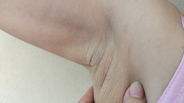 照片显示手指触摸男性手臂下松弛的脂肪皮肤、问题皱纹和腋下毛发。图片下载