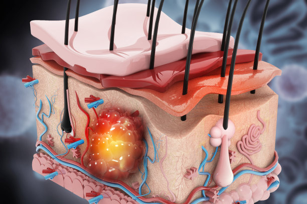 人体皮肤层癌细胞扩散，医学图，3d插图图片下载