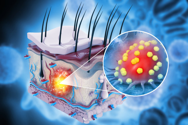 皮肤癌，医学图，癌细胞在人类皮肤层扩散，3d插图图片下载