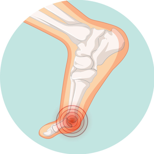 拇外翻类型在圆形模板图片下载