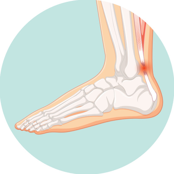 跟腱破裂在圆模板图片下载