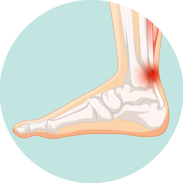 跟腱破裂在圆模板图片下载