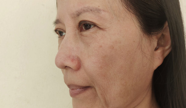 面部松弛脂肪松弛、无光泽。图片下载