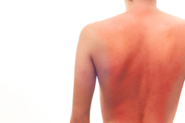 紫外线损伤的概念。背部皮肤被阳光晒伤。图片下载