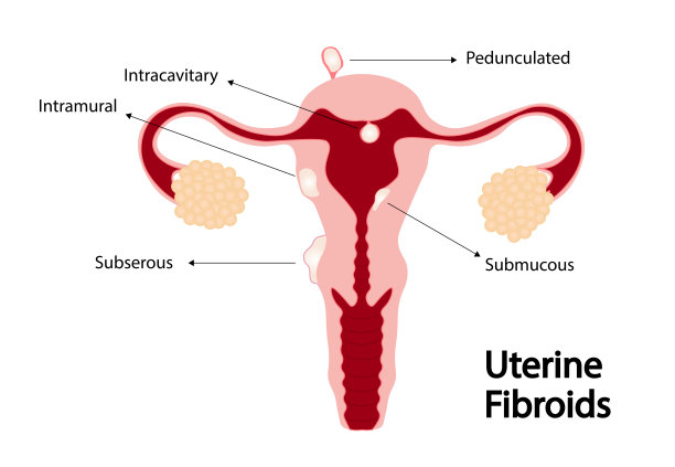 子宫肌瘤插图。图片下载