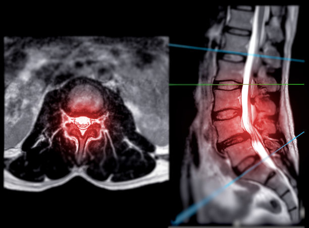 MRI左- s型脊柱或腰椎t2轴位矢状面。图片下载