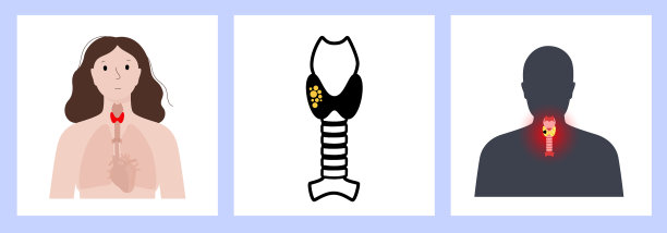 甲状腺图片下载