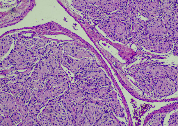 WHO I级脑膜瘤图片下载