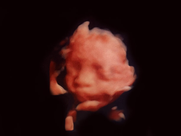 胎儿B超图像图片下载