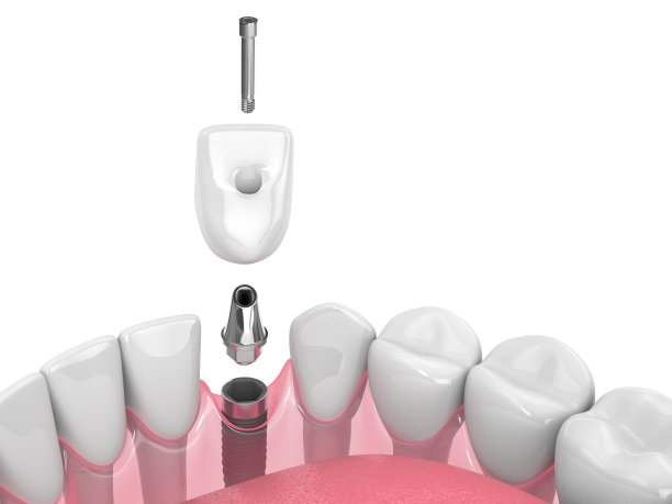 3d渲染牙齿种植在下巴上的白色图片下载
